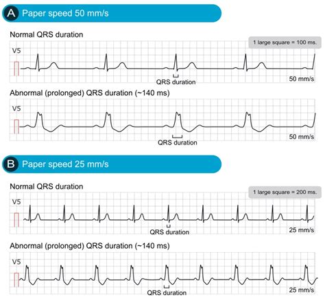 abnormal ekg readings|normal ekg reading vs abnormal.